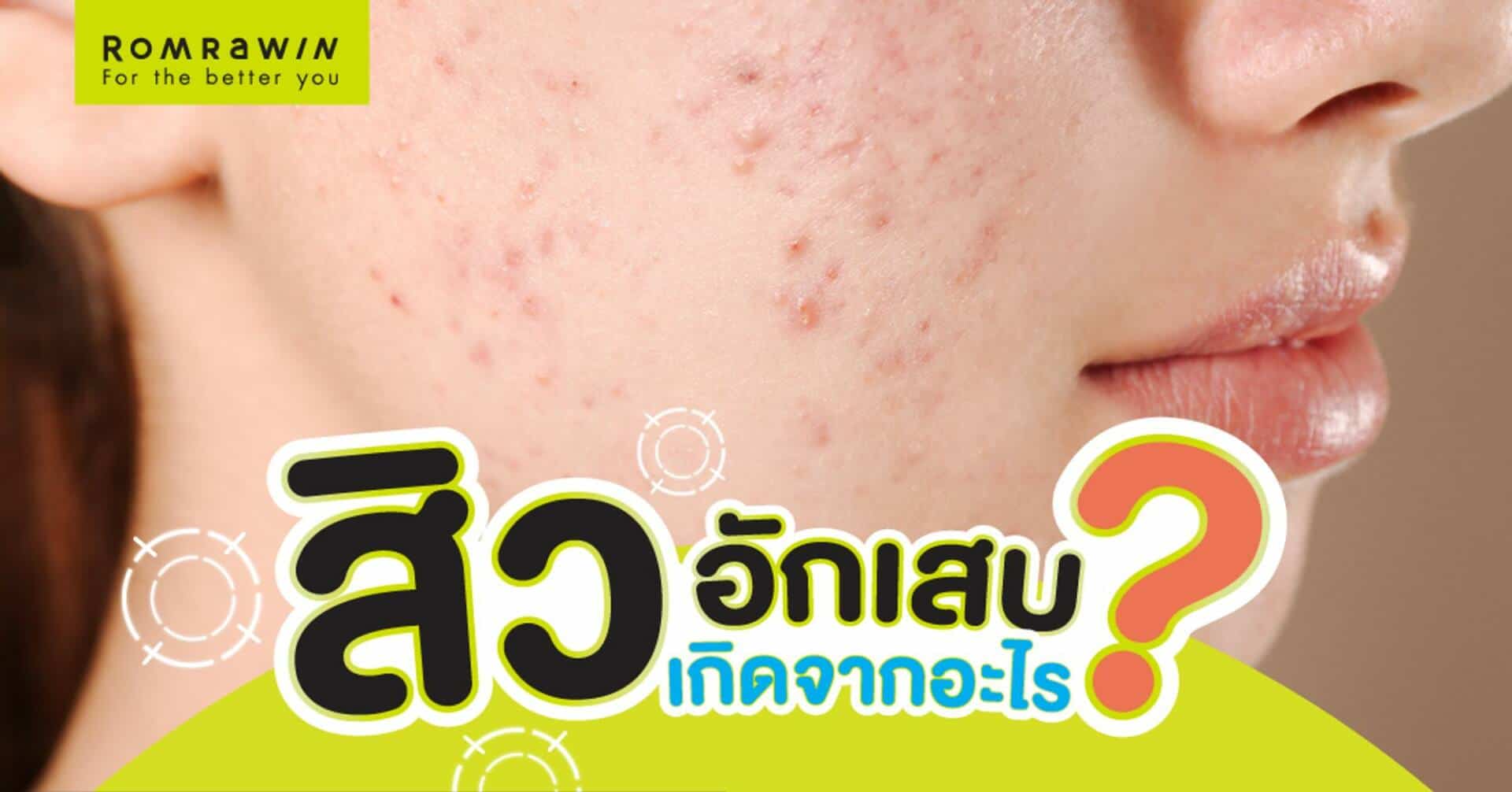 สิวอักเสบ