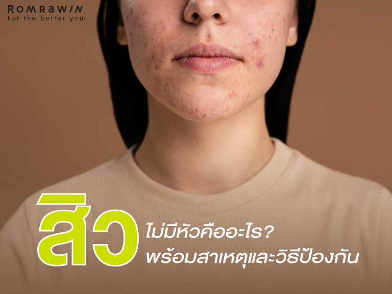 สิวไม่มีหัว