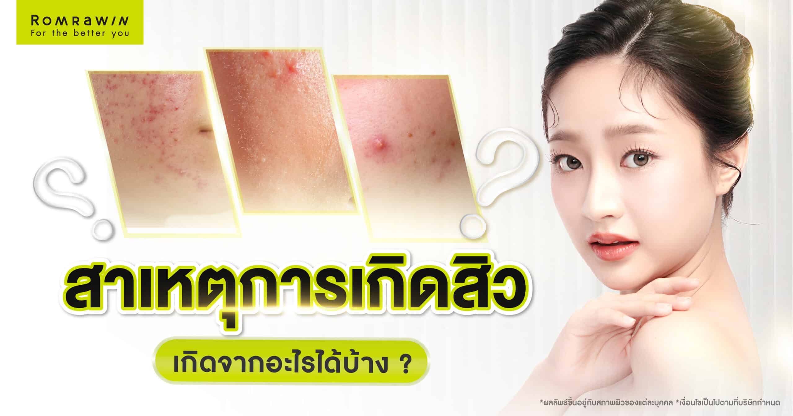 สาเหตุการเกิดสิว เกิดจากอะไรได้บ้าง